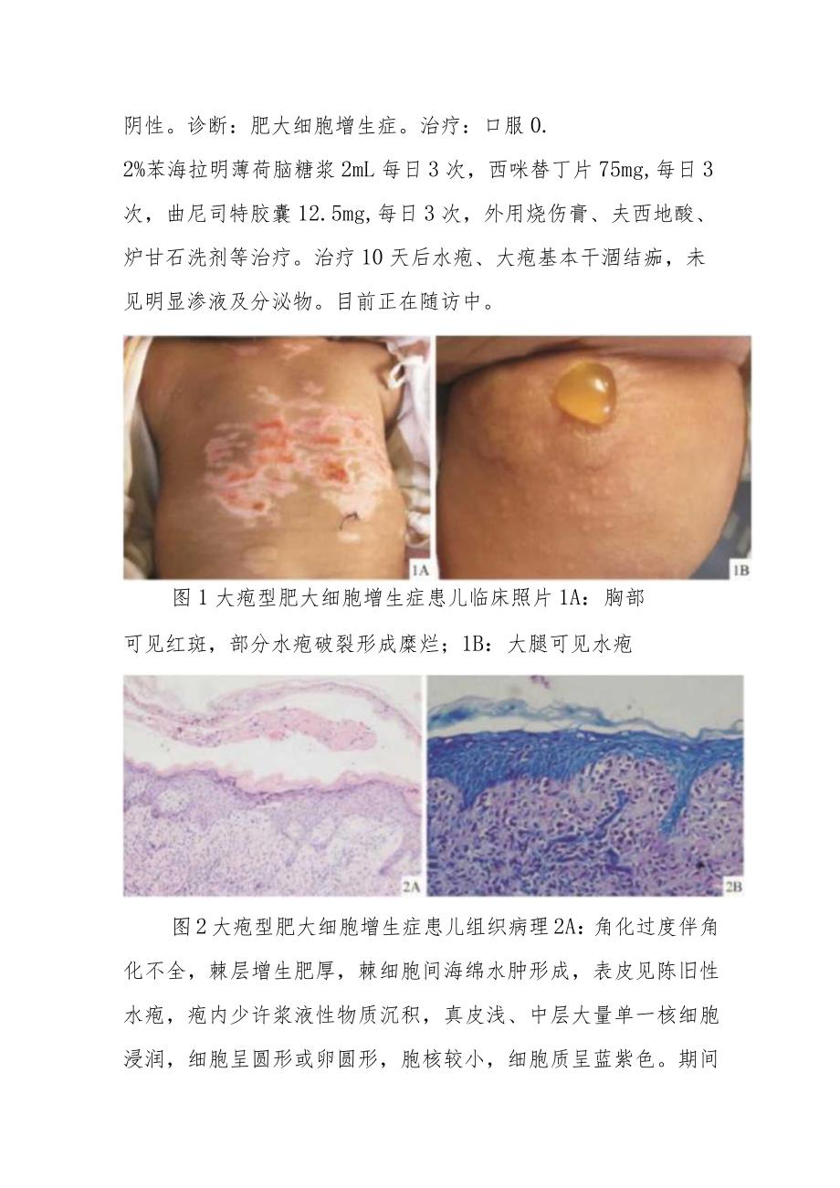 血液科婴儿大疱型肥大细胞增生症病例分析专题报告.docx_第2页