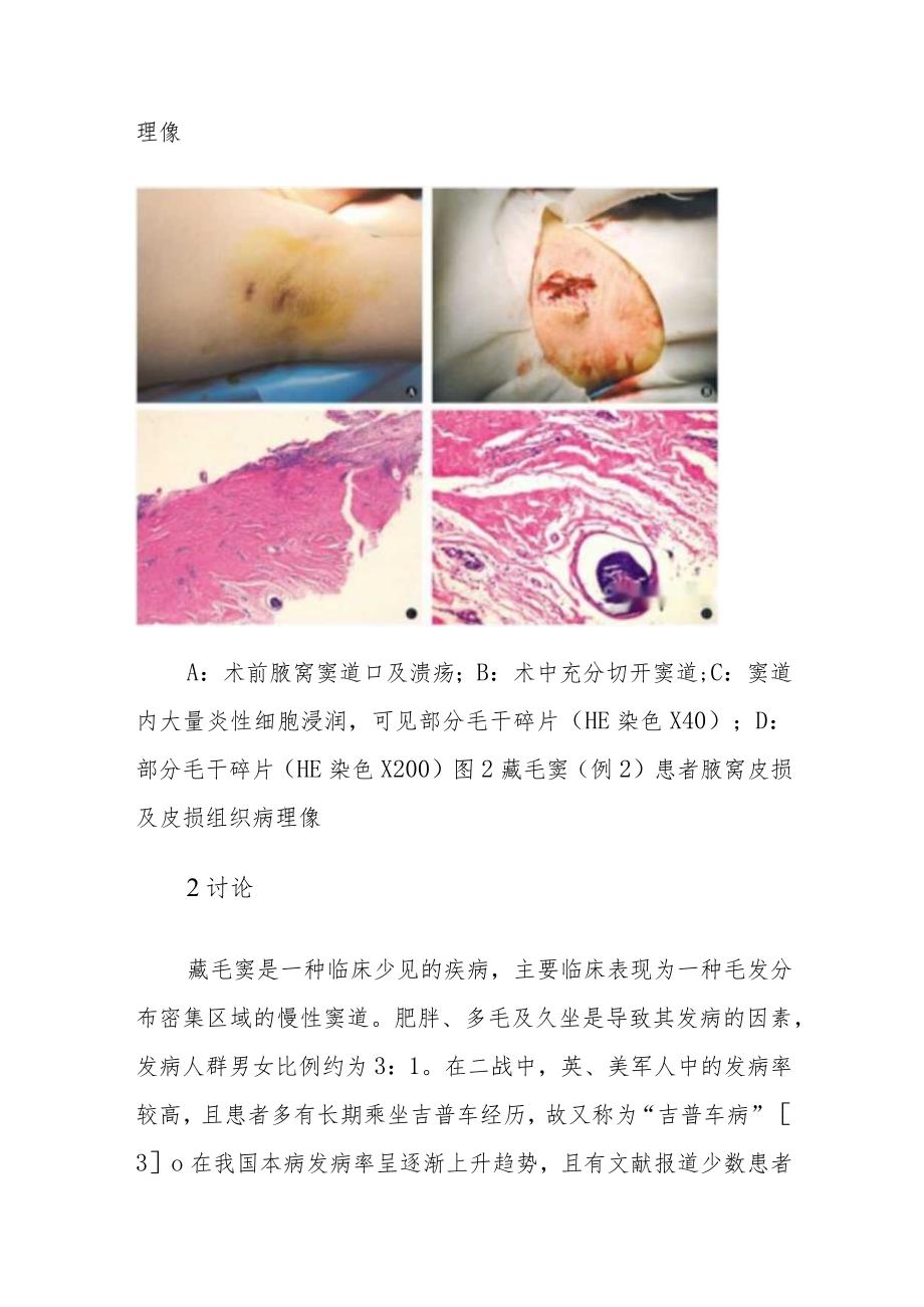 皮肤科藏毛窦病例分析专题报告.docx_第3页