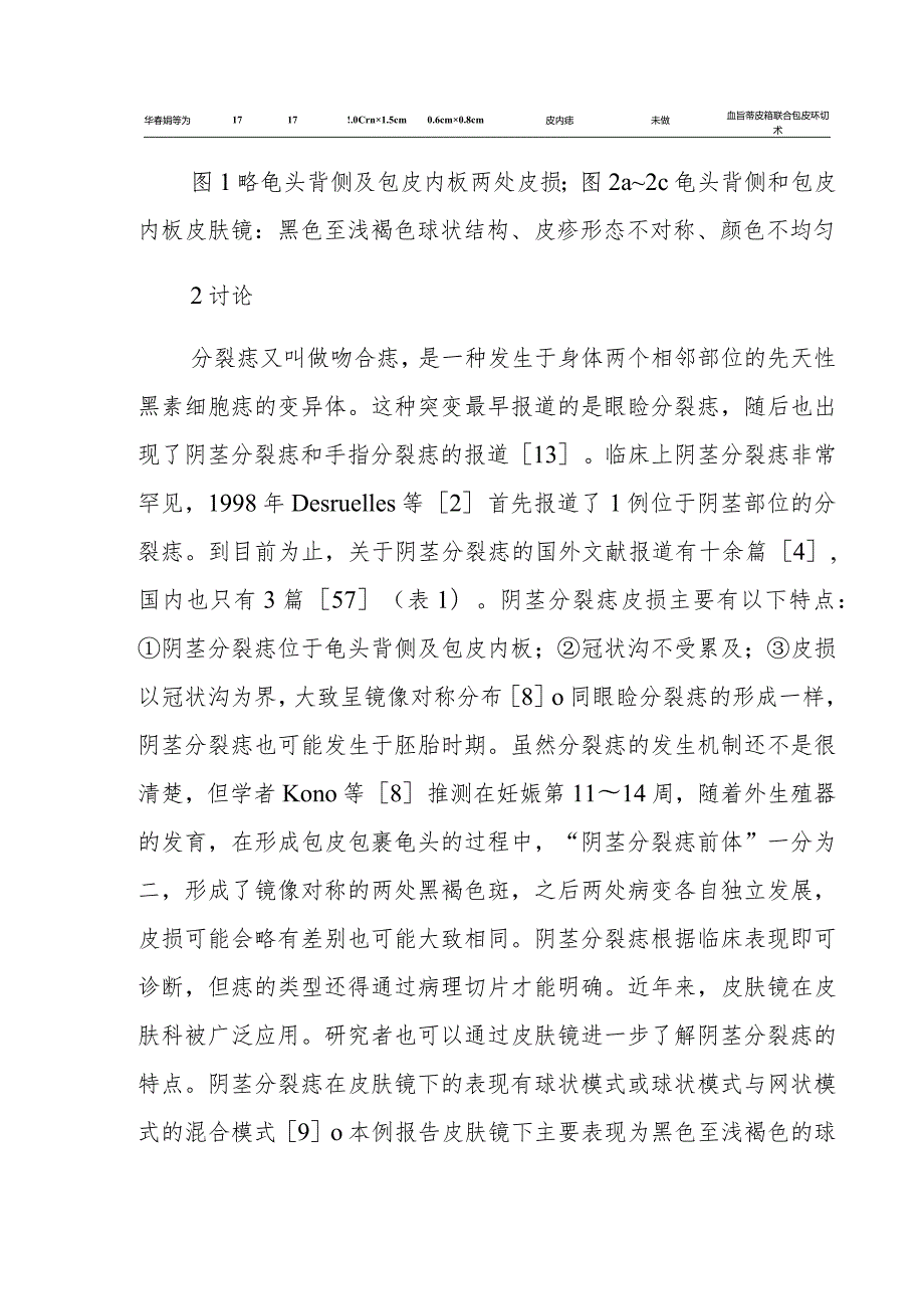 皮肤科阴茎分裂痣病例分析专题报告.docx_第2页