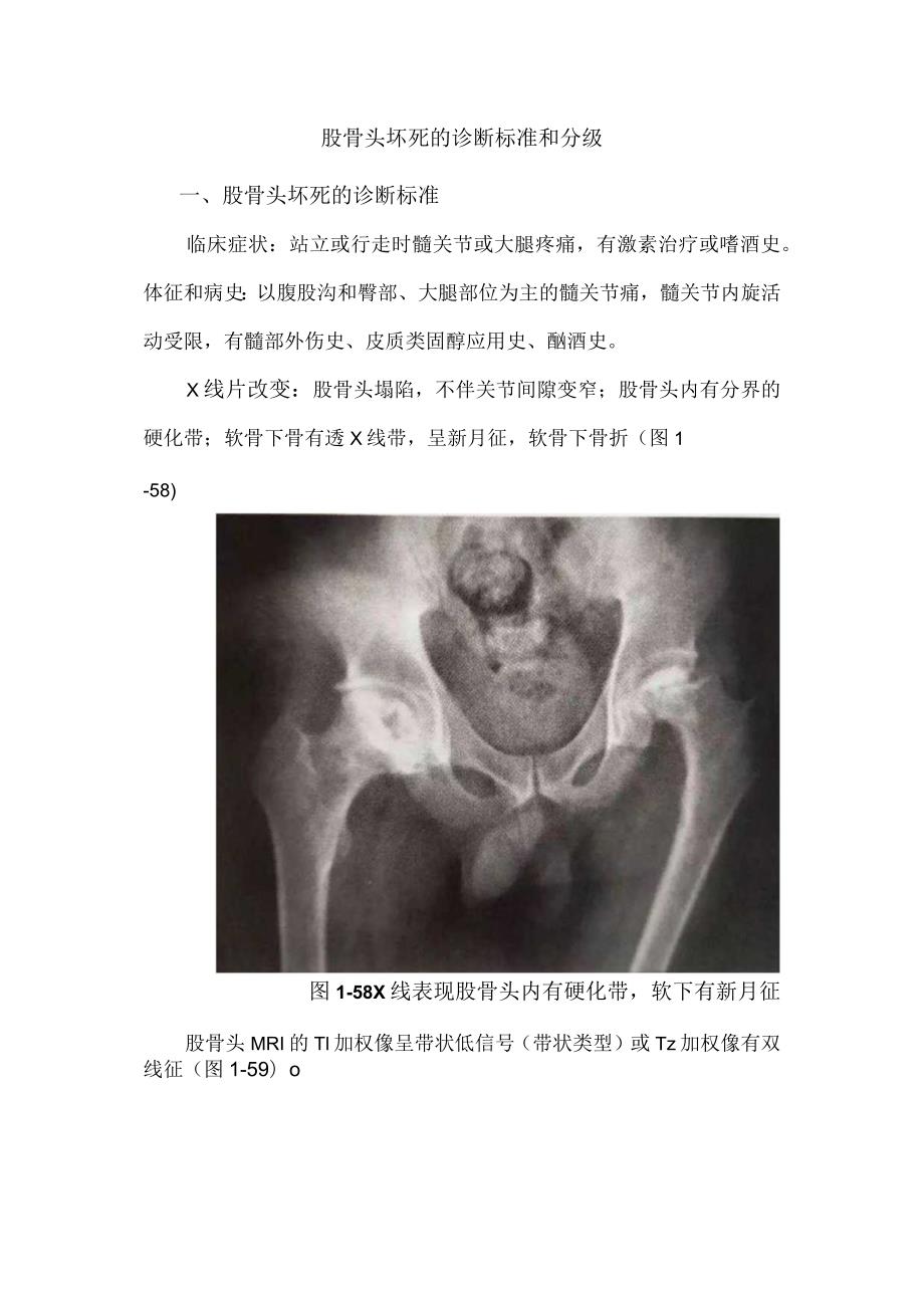 股骨头坏死的诊断标准和分级.docx_第1页