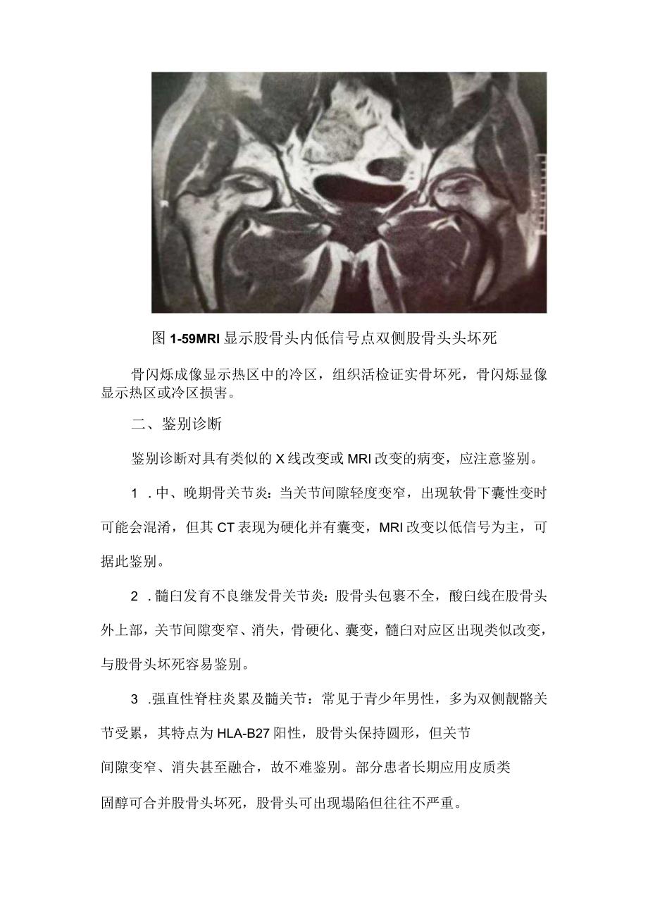 股骨头坏死的诊断标准和分级.docx_第2页