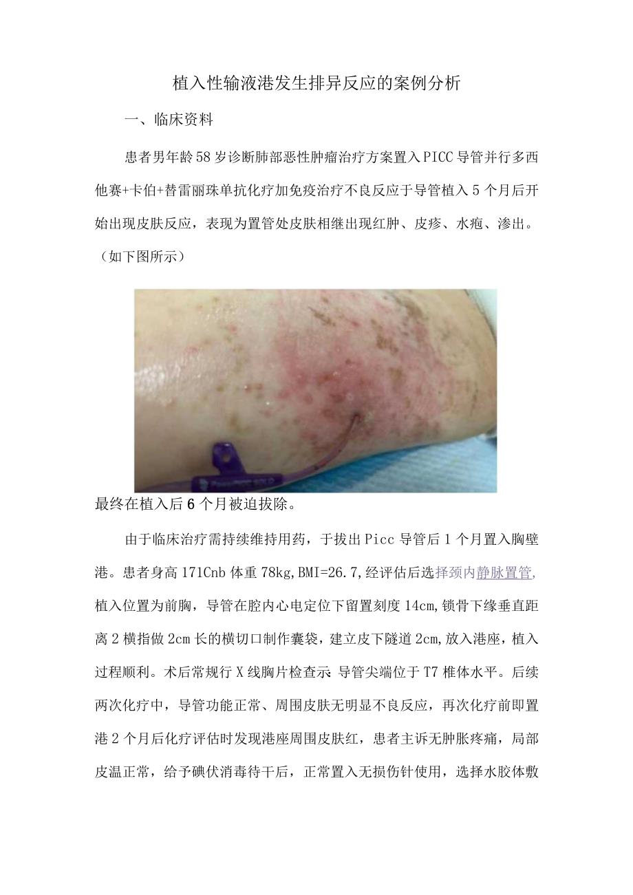 植入性输液港发生排异反应的案例分析.docx_第1页