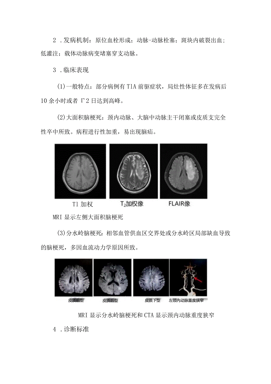 脑梗死常见临床类型特点及诊断标准.docx_第2页