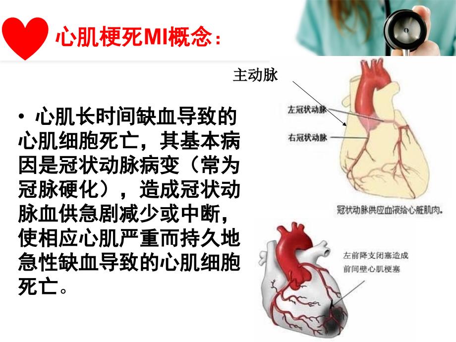 ST段抬高型心肌梗死STEMI.ppt_第3页