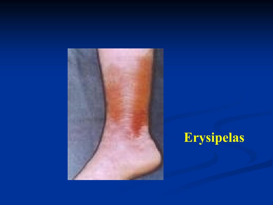 SurgicalInfection外科感染.ppt_第3页