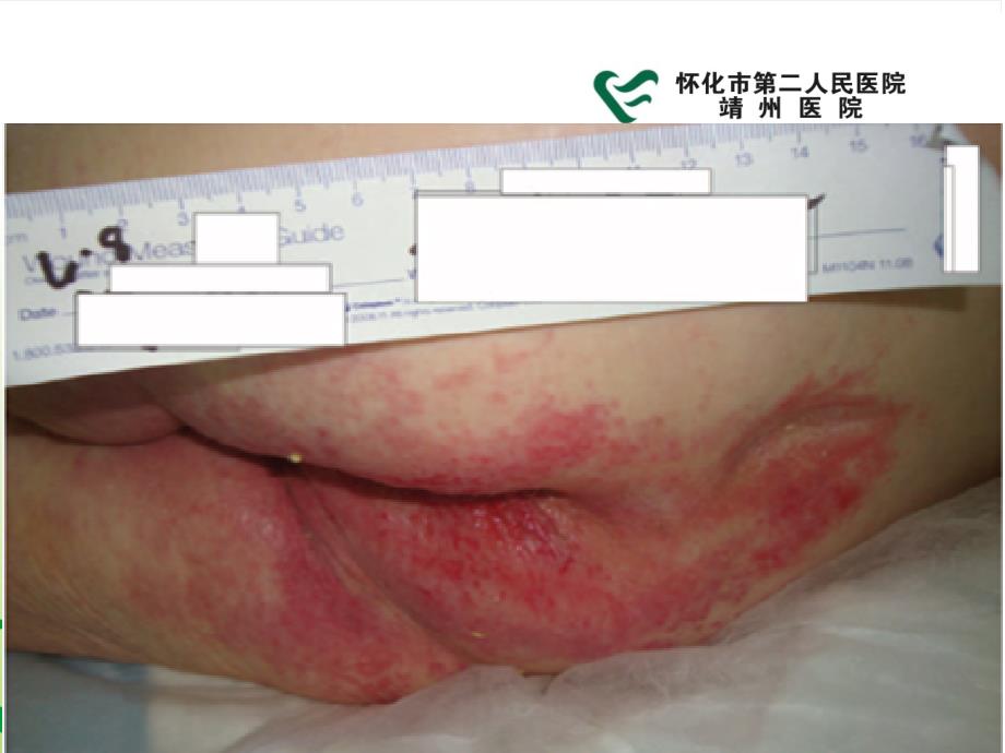 一件式造口袋在大便失禁和便血患者中的应用.ppt_第2页