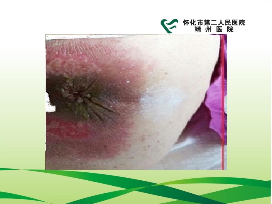 一件式造口袋在大便失禁和便血患者中的应用.ppt_第3页