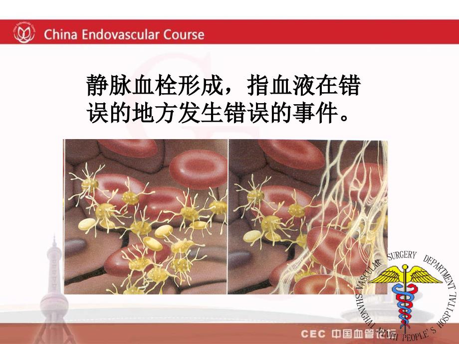 下肢深静脉血栓的治疗.ppt_第2页