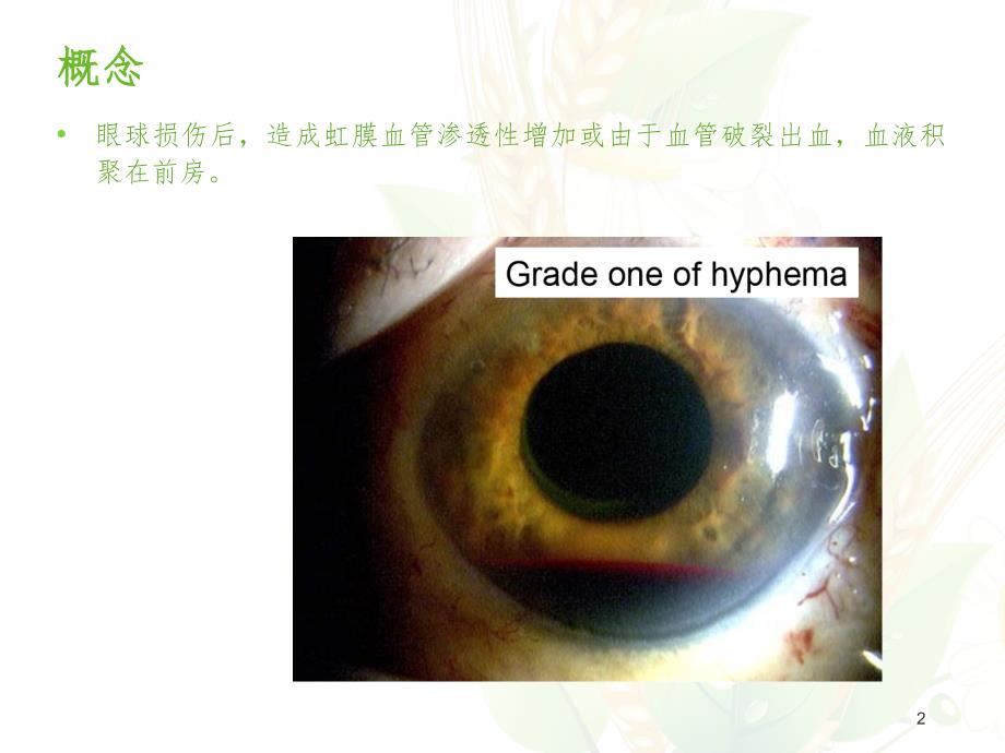 外伤性前房积血PPT精选文档.ppt_第2页