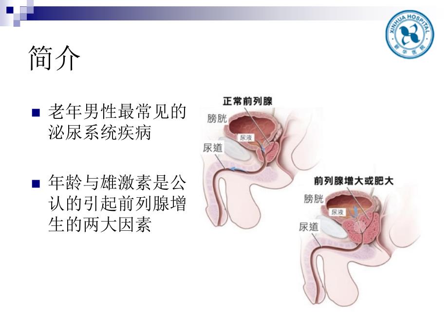 前列腺增生教学查房课件.pptx_第2页