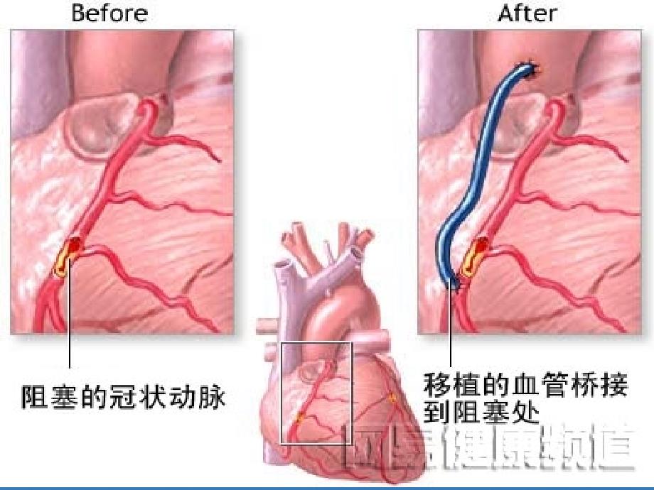 冠脉搭桥术后护理课件.ppt_第3页