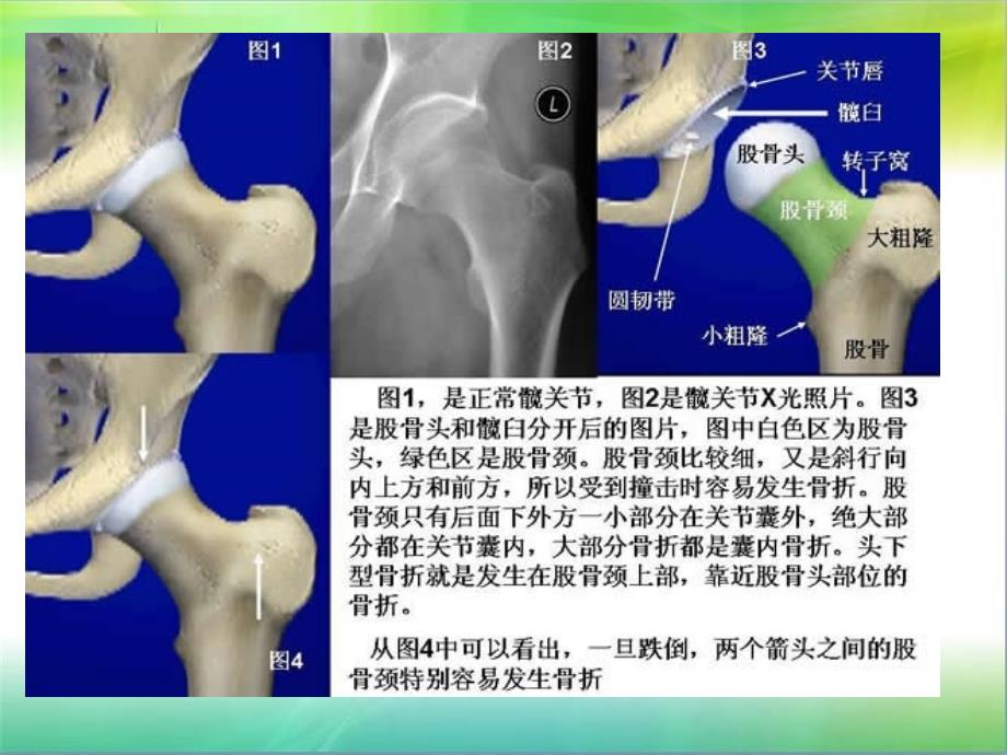 人工髋关节置换术后护理及康复锻炼.ppt_第3页