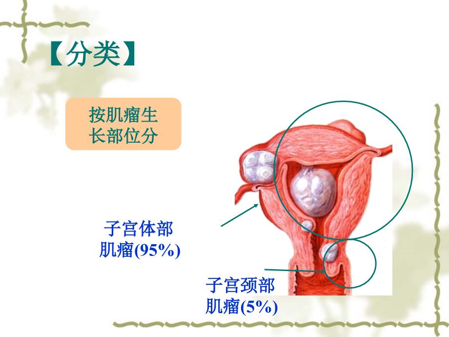 子宫肌瘤护理PPT课件.ppt_第2页