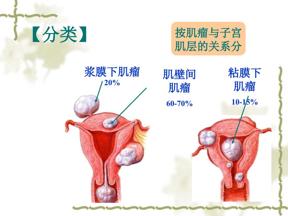 子宫肌瘤护理PPT课件.ppt_第3页
