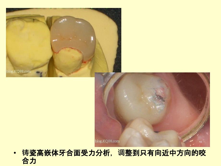 口腔修复病例讨论.ppt_第3页