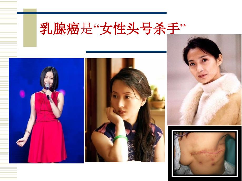 乳腺癌科普宣教.ppt.ppt_第2页