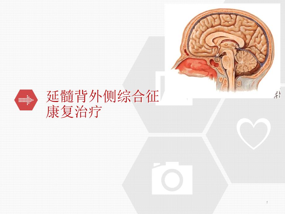 优质课件延髓背外侧综合征的康复治疗.ppt_第1页