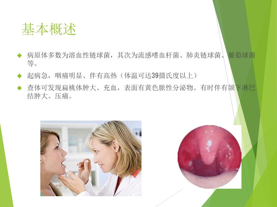 化脓性扁桃体炎.ppt_第2页