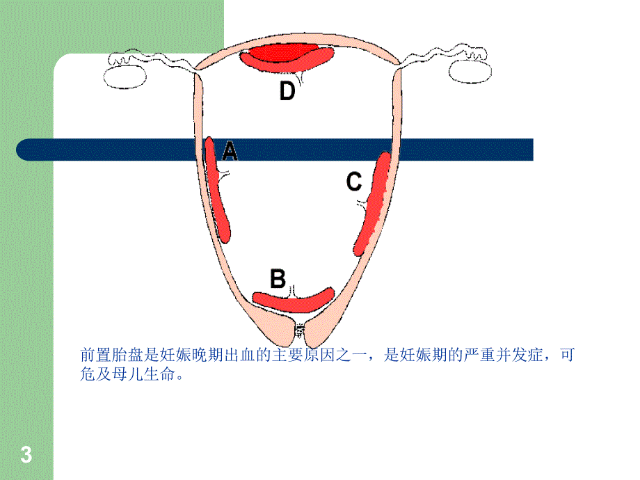 前置胎盘临床诊断与处理指南.ppt_第3页
