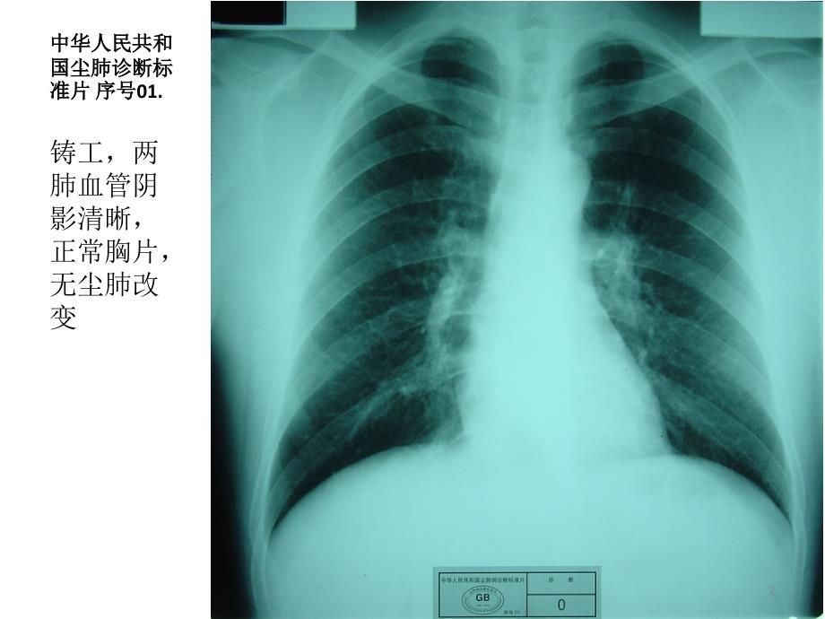 优质课件中华人民共和国尘肺标准片.ppt_第2页