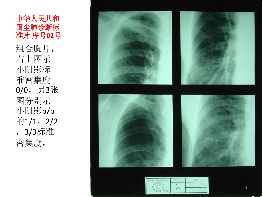 优质课件中华人民共和国尘肺标准片.ppt_第3页