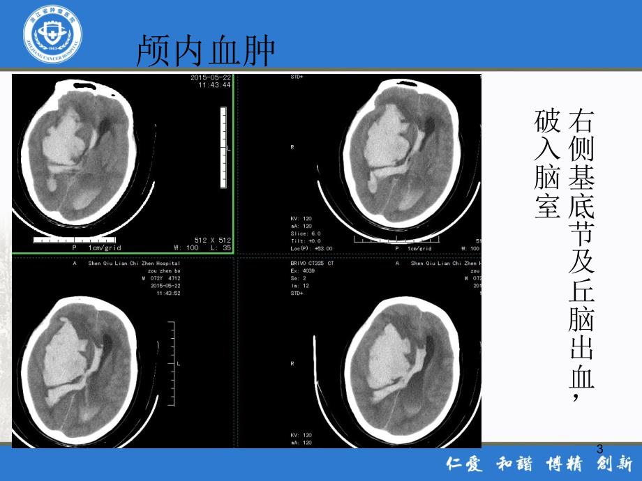 危急值CT课件.ppt_第3页