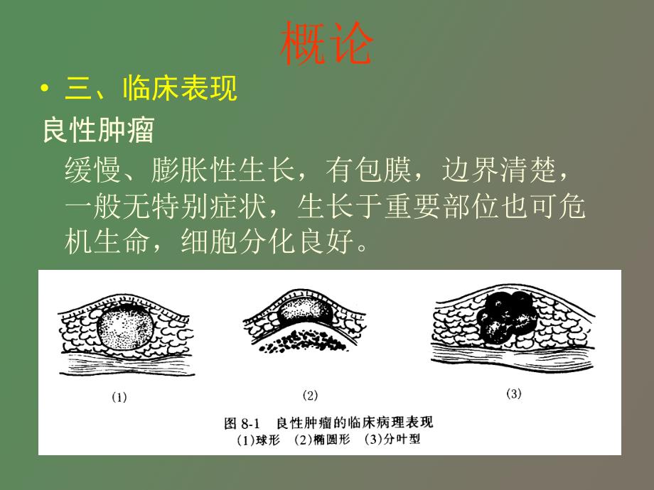 口腔颌面部常见肿瘤.ppt_第3页