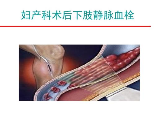 妇科手术后下肢静脉血栓PPT课件.ppt