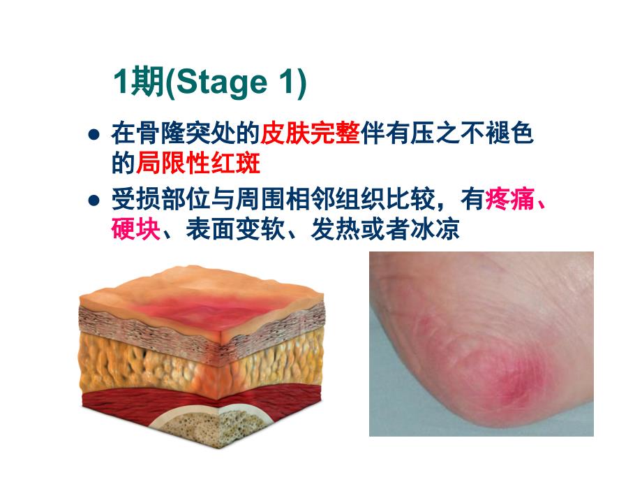 压疮新进展以及手术压疮预防.ppt_第3页