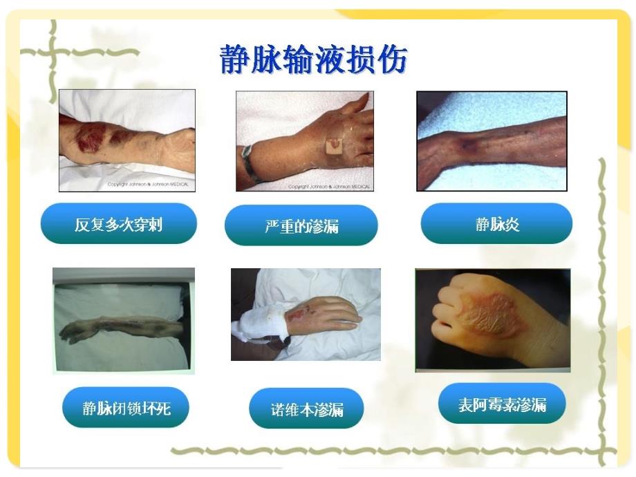 小儿静脉输液外渗的预防及处理.ppt_第3页