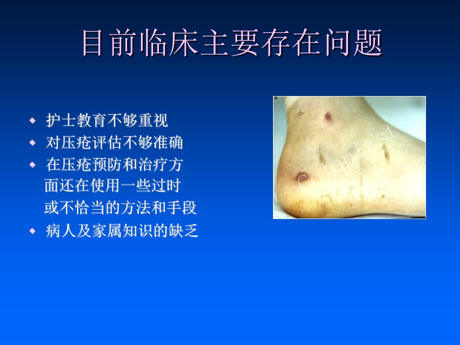 压疮PPT课件.ppt_第2页
