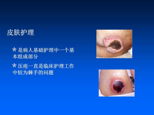 压疮PPT课件.ppt
