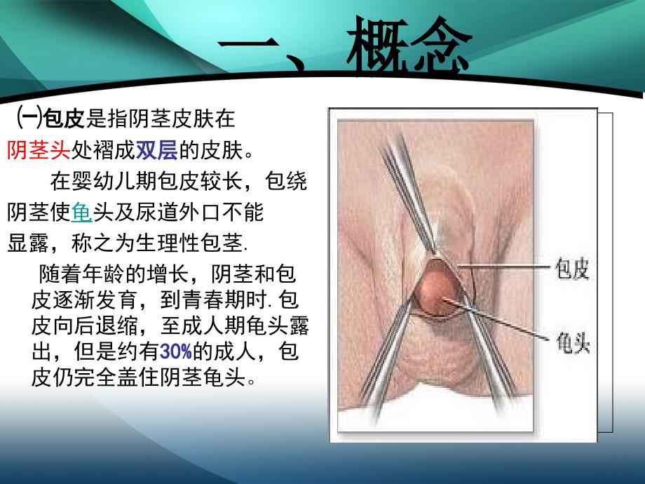 包皮包茎课件.ppt_第3页