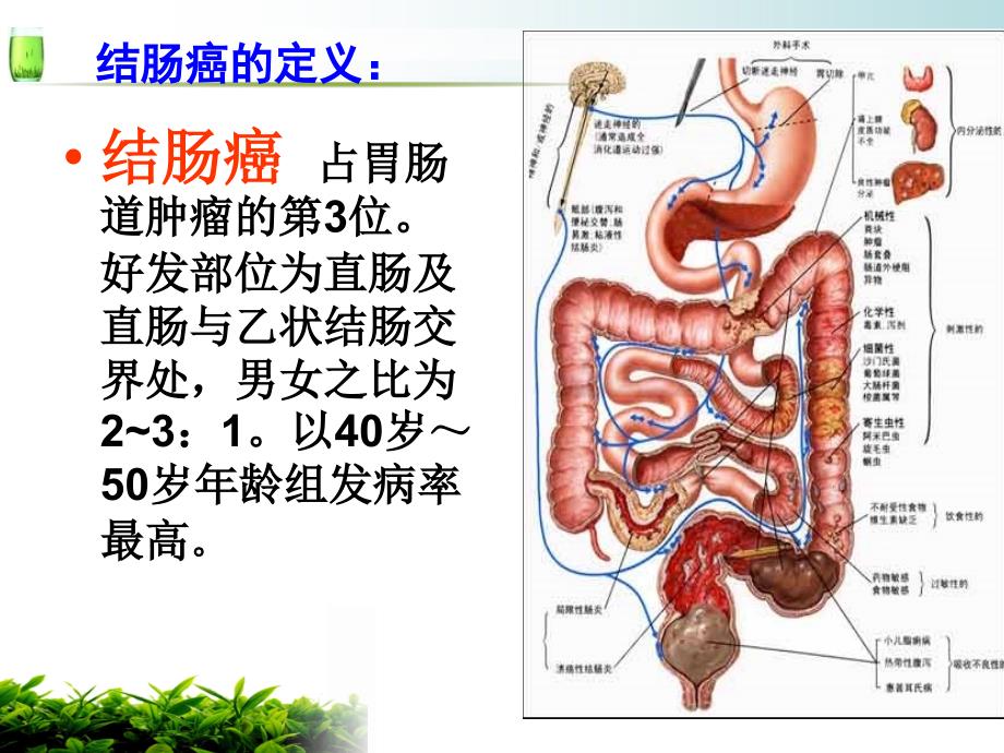 乙状结肠癌护理查房.ppt_第2页