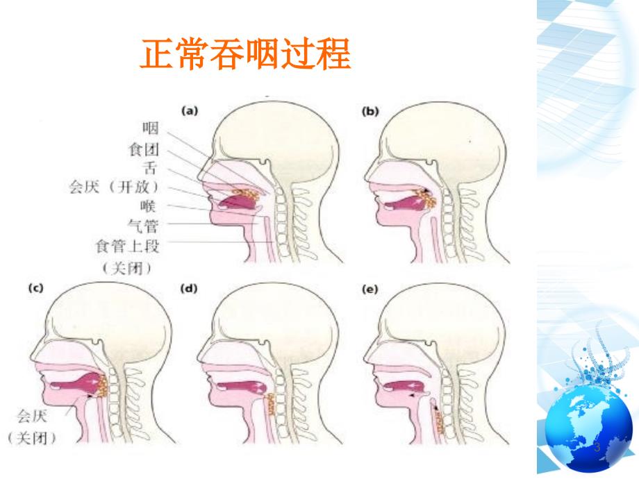 优质课件老年人住院期间误吸的预防与处理.ppt_第3页