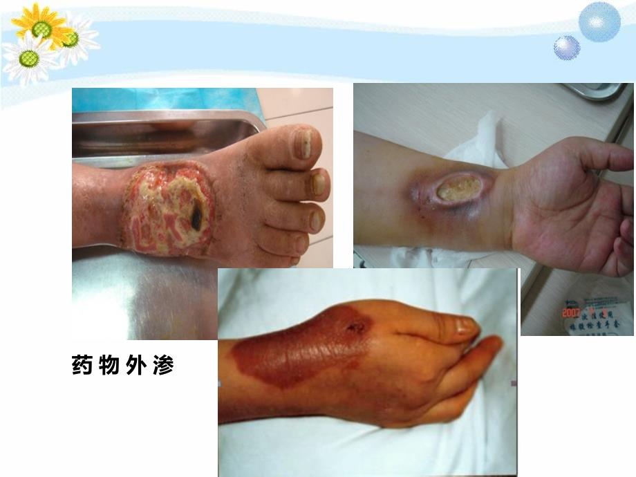 医学ppt静脉输液治疗新进展.ppt_第2页