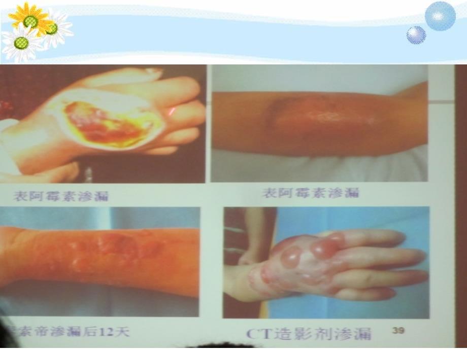 医学ppt静脉输液治疗新进展.ppt_第3页