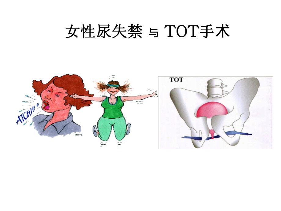 压力性尿失禁TOT治疗ppt课件.ppt_第1页