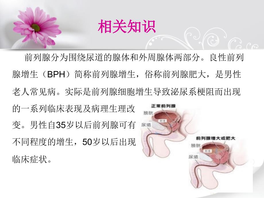 前列腺增生术后护理.ppt_第2页