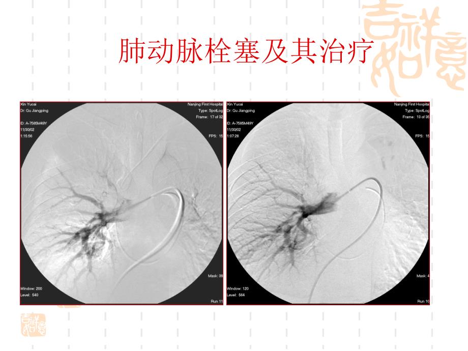 下腔静脉滤器置入术课件.ppt_第3页