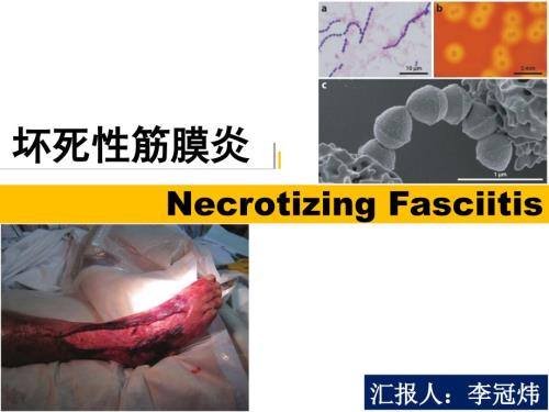 坏死性筋膜炎.pptx