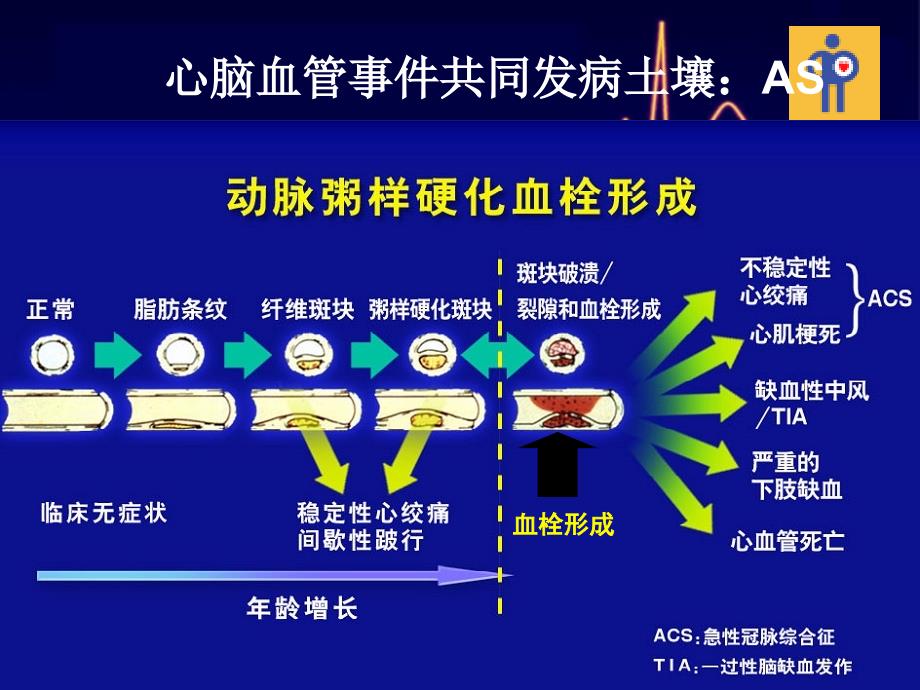 合并脑卒中的急性冠脉综合征患者抗栓治疗.ppt_第3页