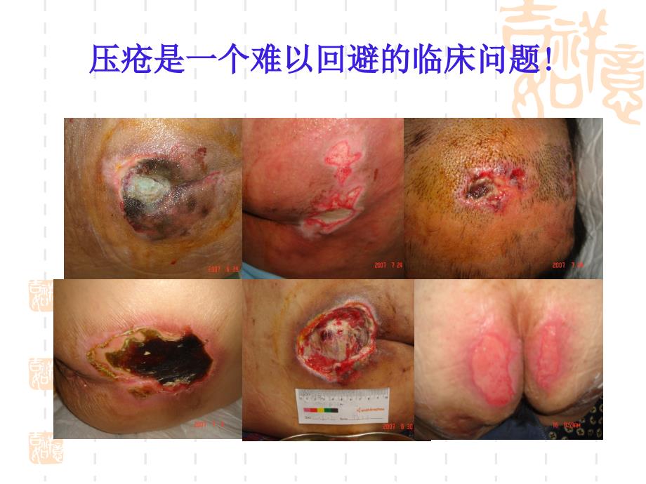 压疮的分期课件.ppt_第3页