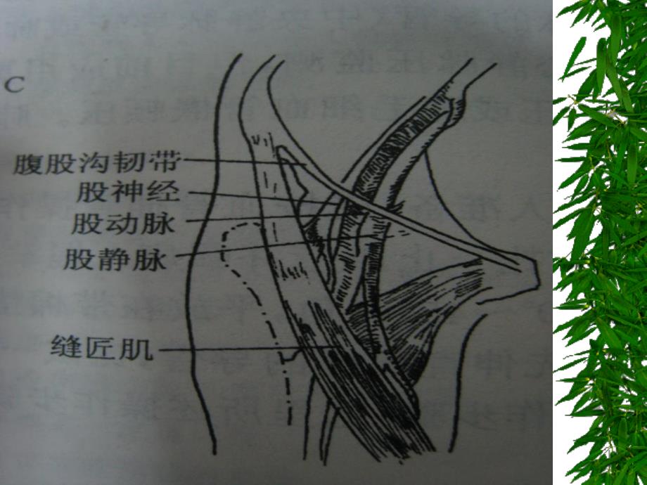 假性动脉瘤PPT课件.ppt_第3页