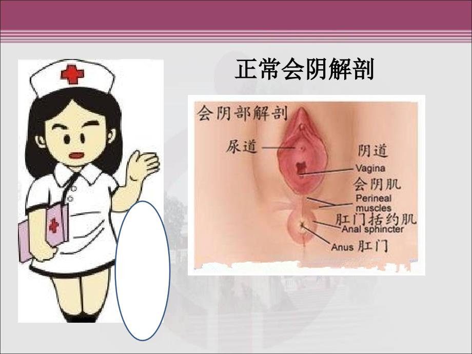 会阴三四度裂伤的护理ppt课件.ppt_第3页