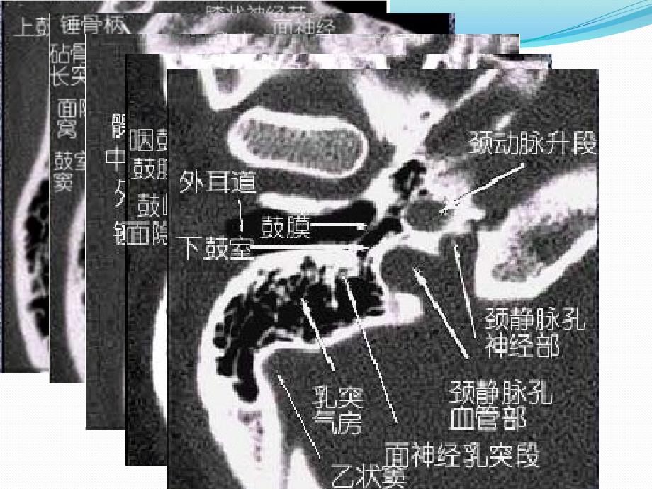 中耳乳突炎的CT诊断.ppt_第3页