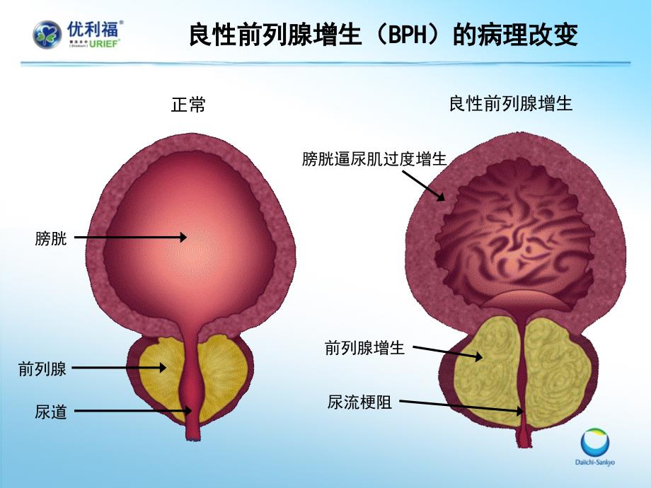 医学交流课件优利福赛洛多辛新型超高选择性1A受体阻滞剂.pptx_第3页