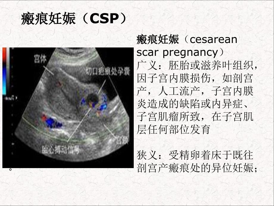 子宫瘢痕妊娠ppt课件.ppt_第2页