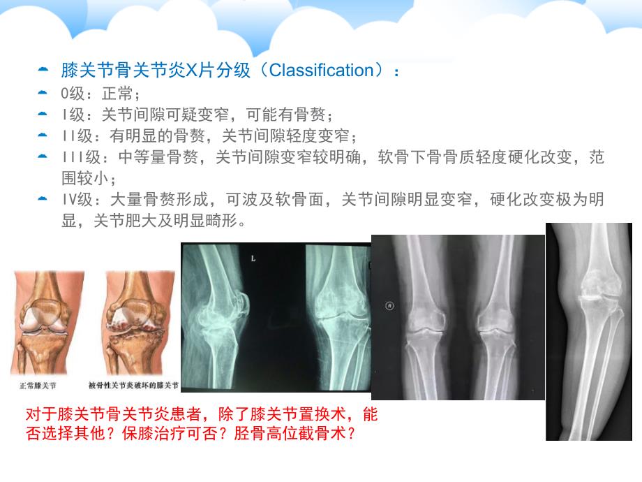 保膝治疗之1胫骨高位截骨术.ppt_第2页