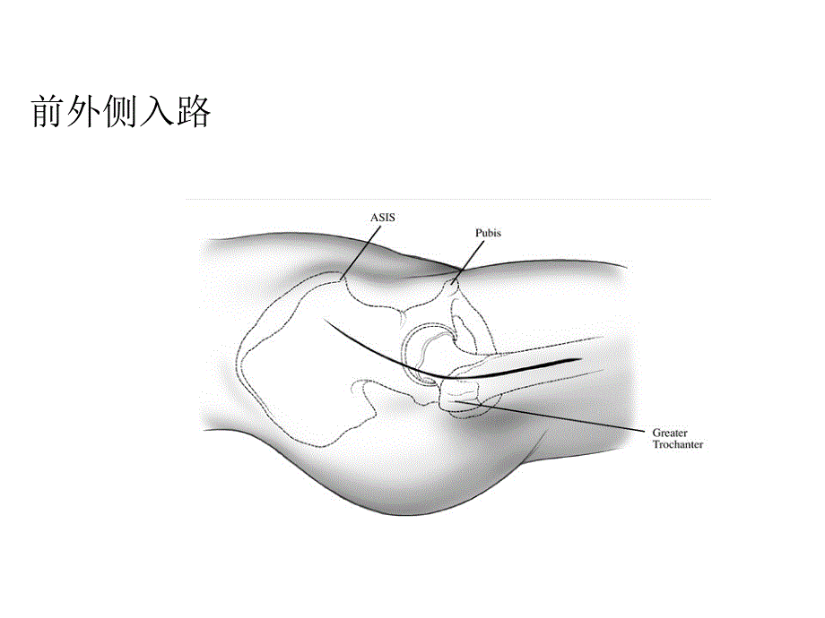 初次全髋关节置换手术技术要点.ppt_第3页